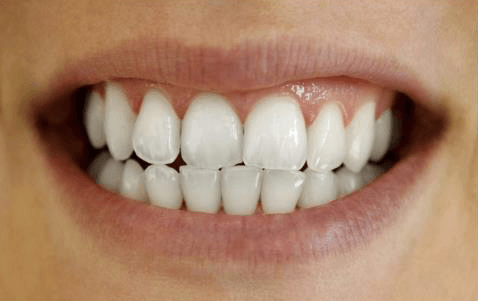 Sbiancamento dentale