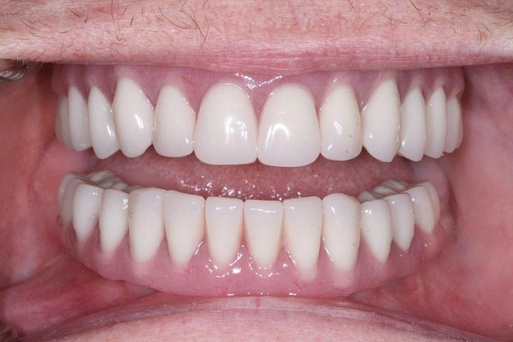 After full mouth rehab: Upper and Lower all on six