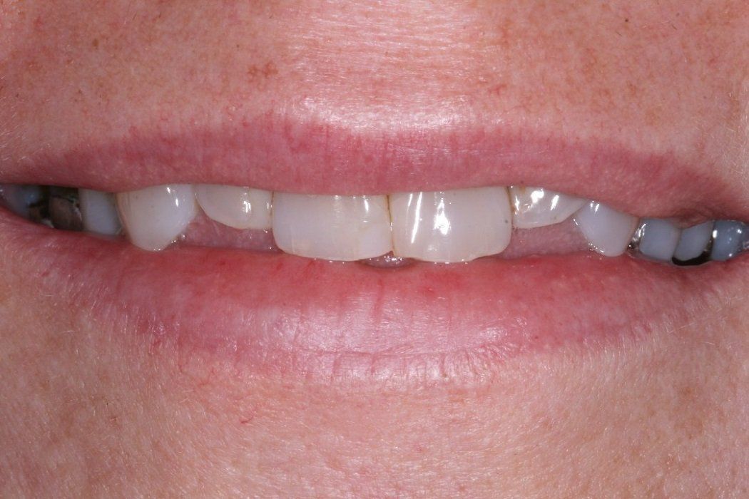 Before Full ceramic crowns and veneers