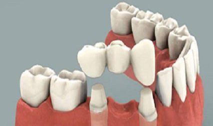 Smile Makeover, Saugus, MA