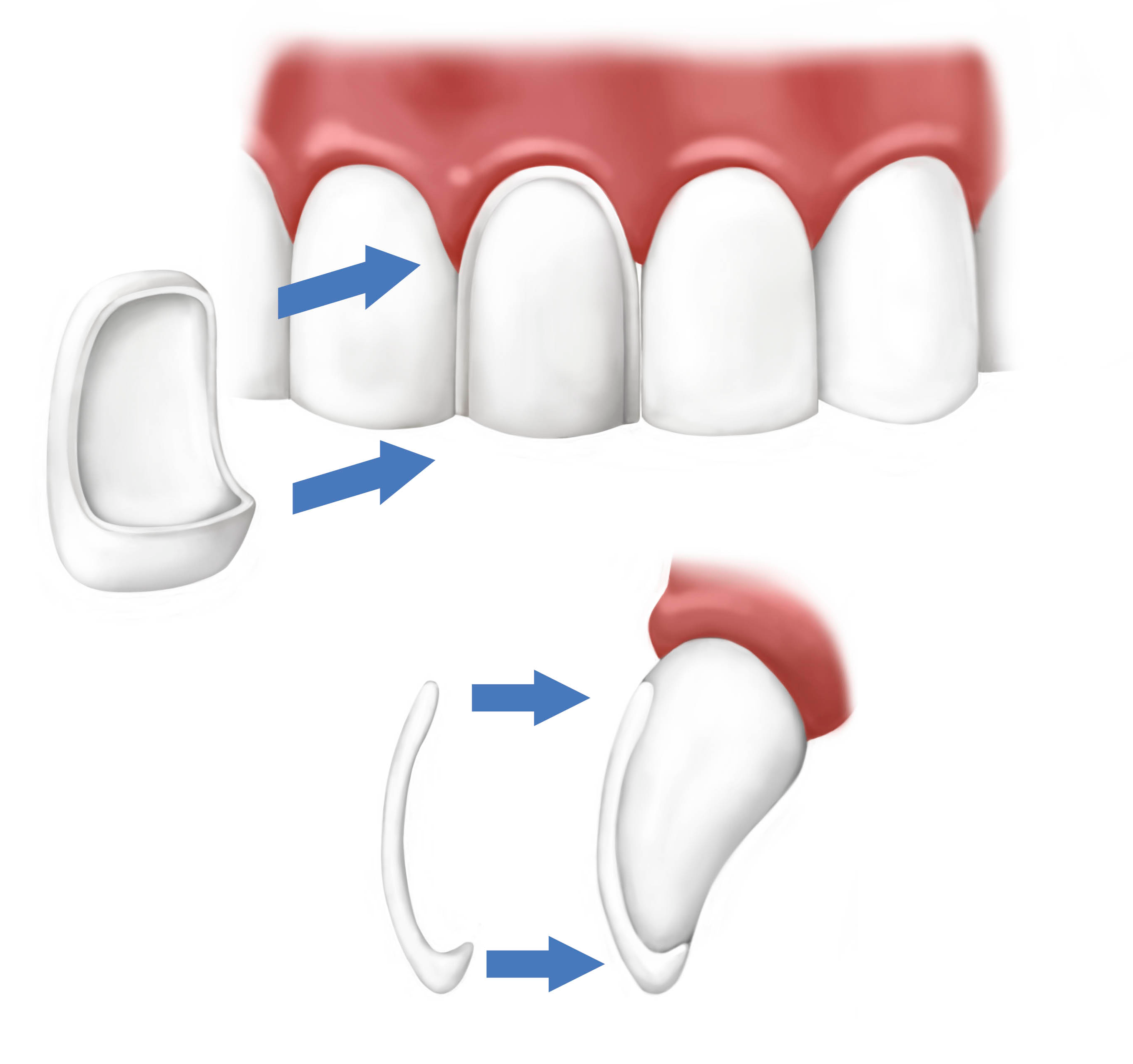 Dental Veneers, Saugus, MA