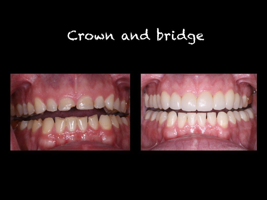 Crown and bridge