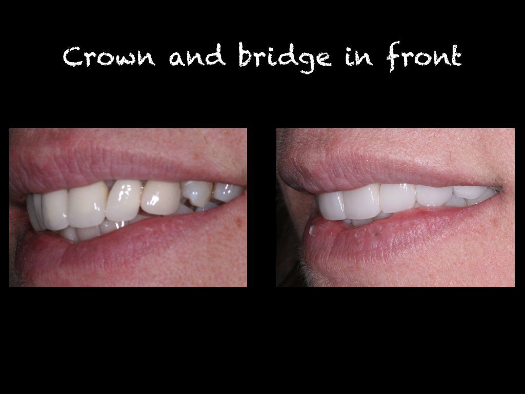Crown and bridge in front