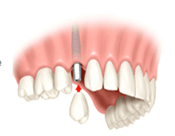 Implant Supported Dentures, Saugus, MA