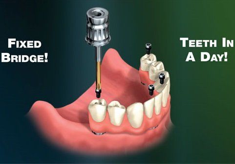 Implant Supported Dentures, Saugus, MA