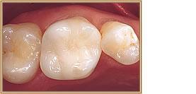 Close-up of three teeth; the center tooth is the largest. Surrounding gum tissue is visible.