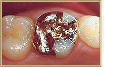 Close-up of a mouth showing a tooth with a silver and white filling between two natural teeth.