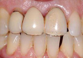 Close-up view of teeth with dental crowns and metal margins.