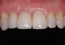 Close-up of healthy upper teeth and gums; white teeth with a slight sheen against pink gums.