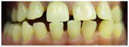 Close-up of teeth with a gap between the two front teeth; teeth are slightly yellow.
