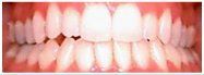 Close-up of human teeth, showing a smile. Teeth appear white with some small dark spots.