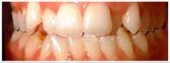 Close-up of teeth. Some teeth show signs of damage or wear, with discoloration and cracks visible.