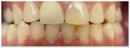 Close-up of human teeth, showing a full set with a slightly yellow shade. The gums are pink.