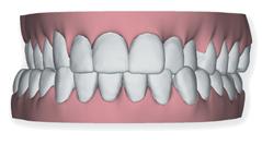 3D model of teeth with slight overbite and some crowding.