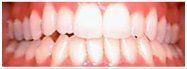 Close-up of human teeth, showing a full set with a few small dark spots.