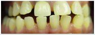 Close-up of teeth, displaying a yellow-ish color and slight gap between front teeth.