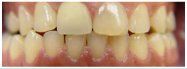 Close-up of teeth, top and bottom rows visible, with light yellowing.