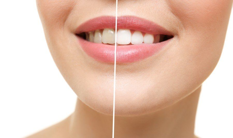 Side-by-side comparison of teeth. The left side shows dull teeth, and the right side shows bright white teeth.