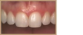 Close-up of human teeth, showing healthy, white teeth. Gums are pink.