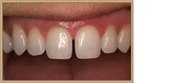 Close-up of human teeth, showing a noticeable gap between the two front teeth and healthy gums.