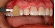 Mouth with teeth, shade comparison. A yellow shade tab held next to teeth, showing color difference.