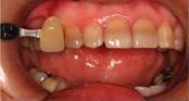Mouth with teeth; dental shade guide shows yellow tooth against natural teeth, with pink gums and red lips.