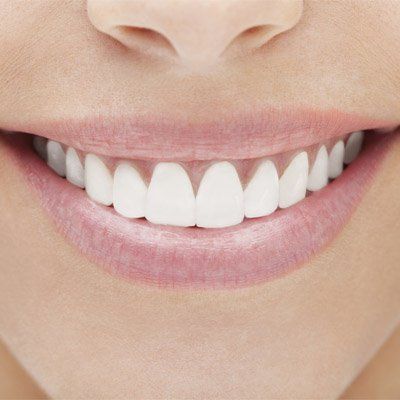 Woman Smile — Bleaching in Silver Spring, MD
