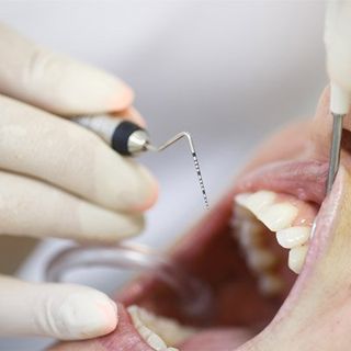 Periodontal Probe —  Periodontics in Silver Spring, MD
