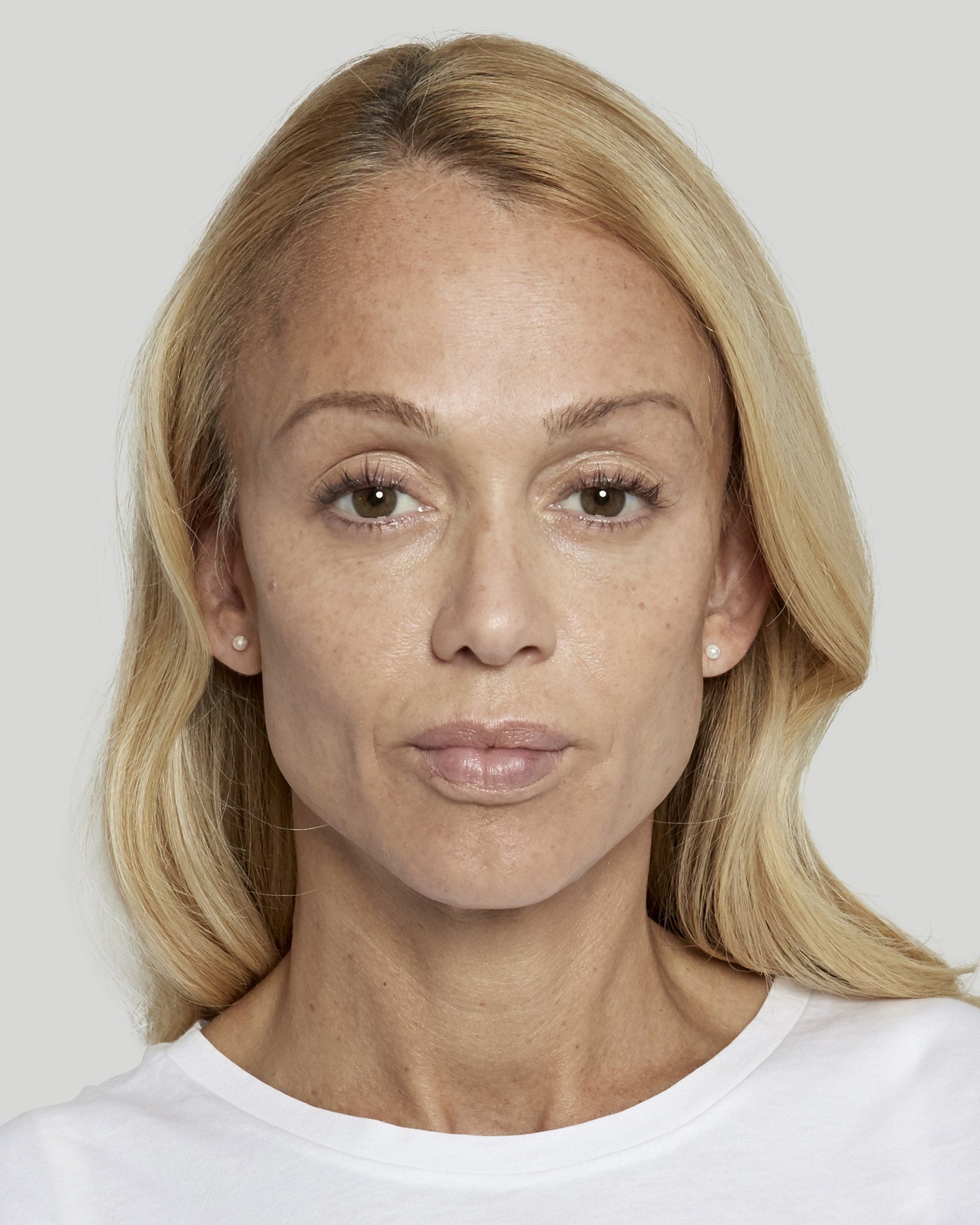 Galderma Fillers - after photo