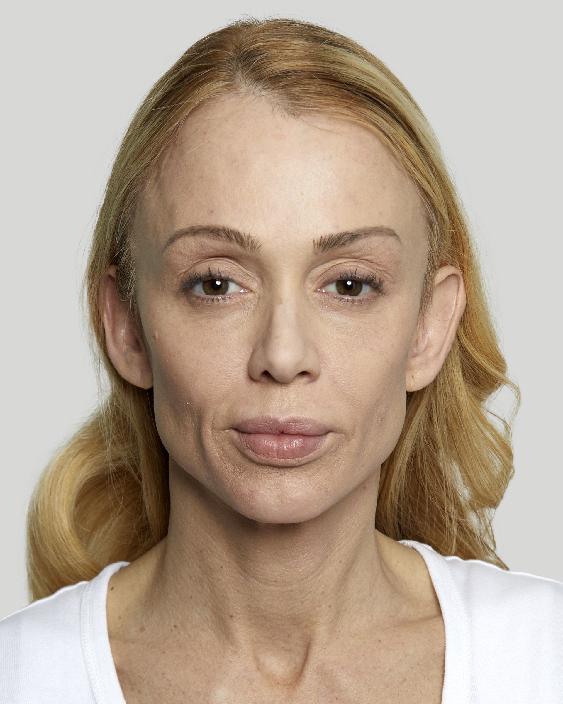 Galderma Fillers - before photo