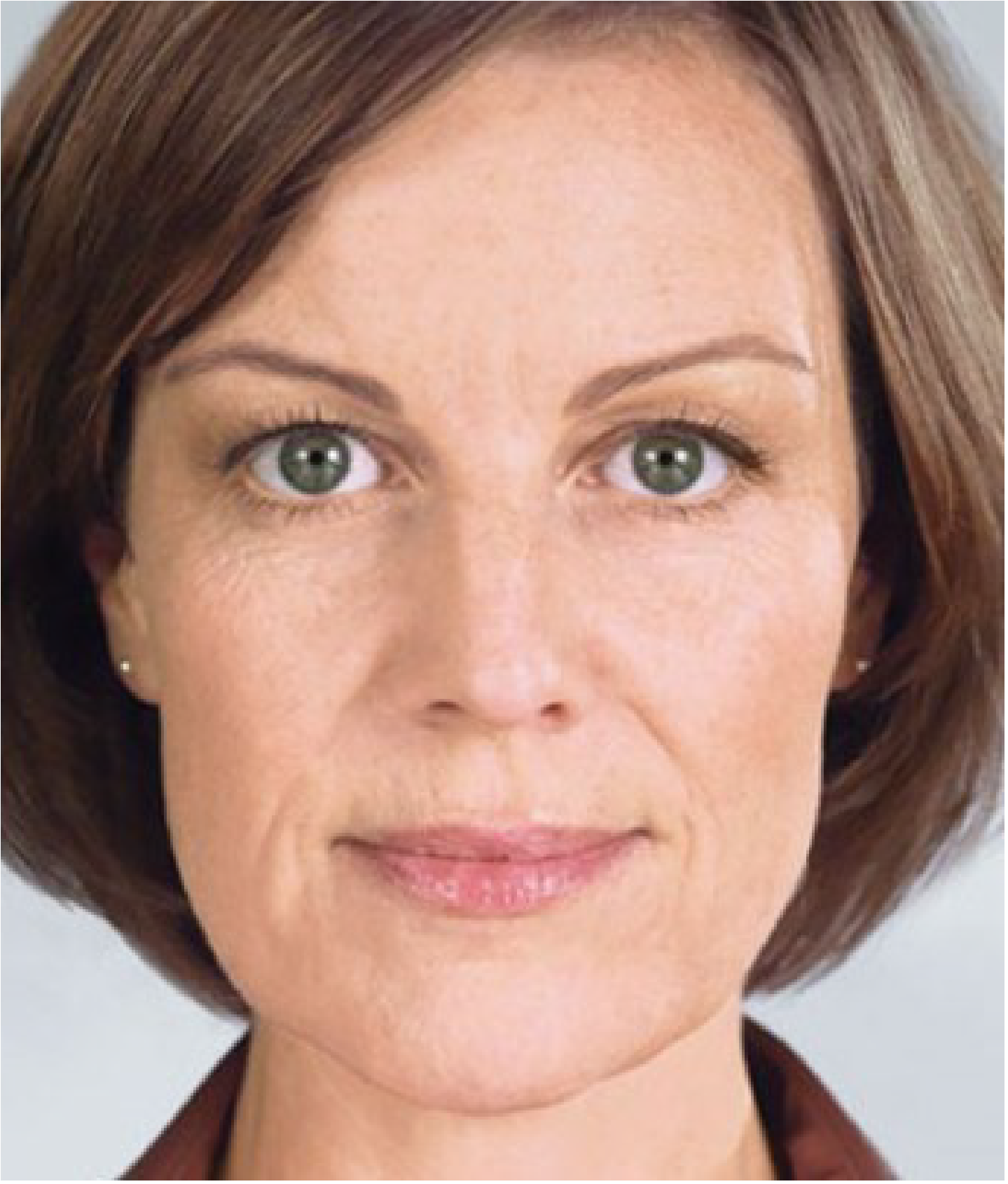 Galderma Fillers - after photo