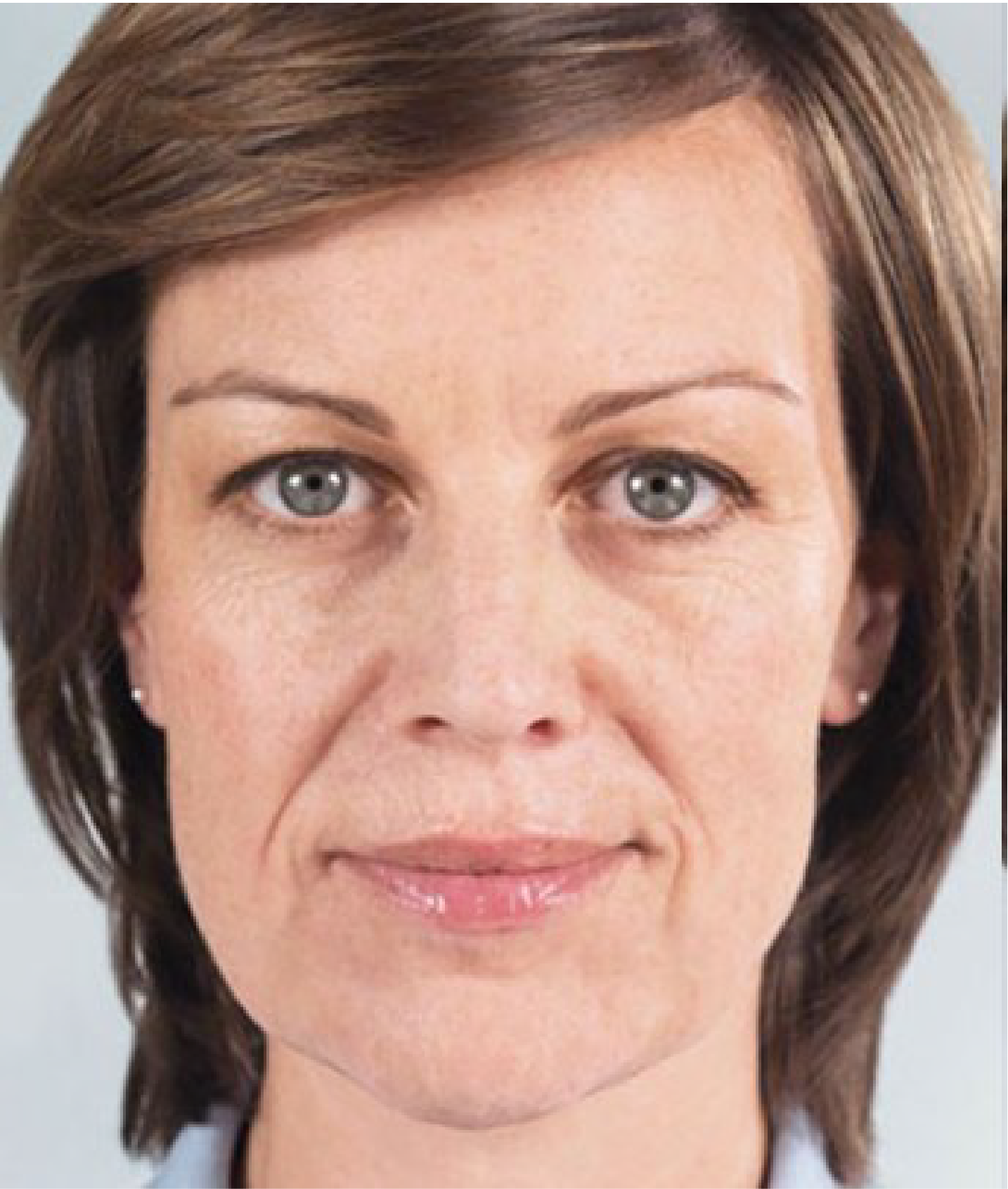 Galderma Fillers - before photo