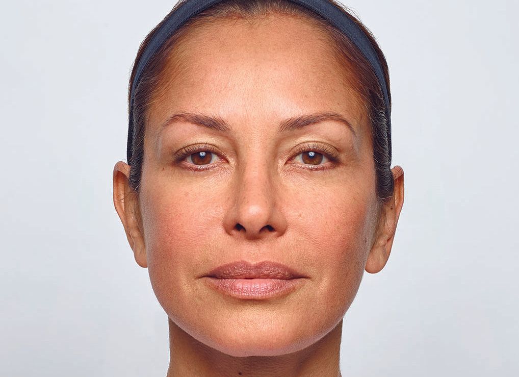 Injectables- after photo