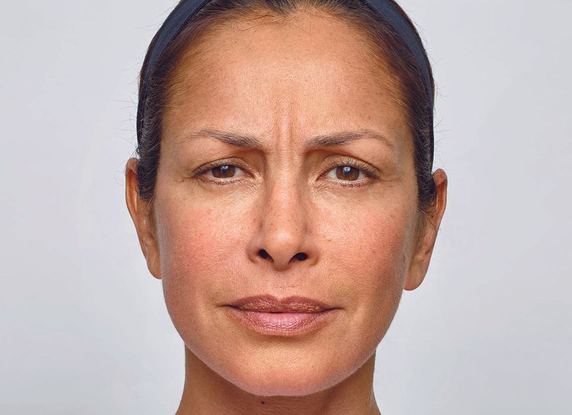 Injectables- before photo