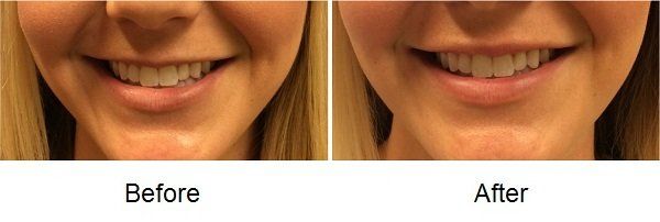 Galderma Fillers - A before and after picture of a woman 's smile