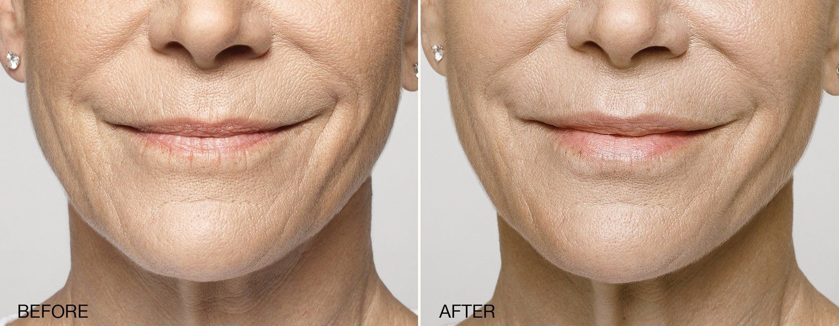 Galderma Fillers - A before and after photo of a woman 's face.