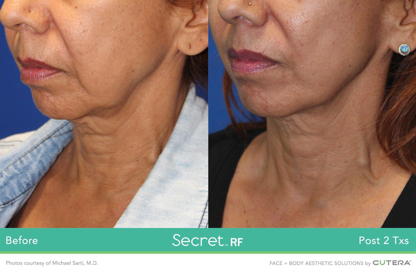 Photo of a woman 's neck and face before and after Secret RF
