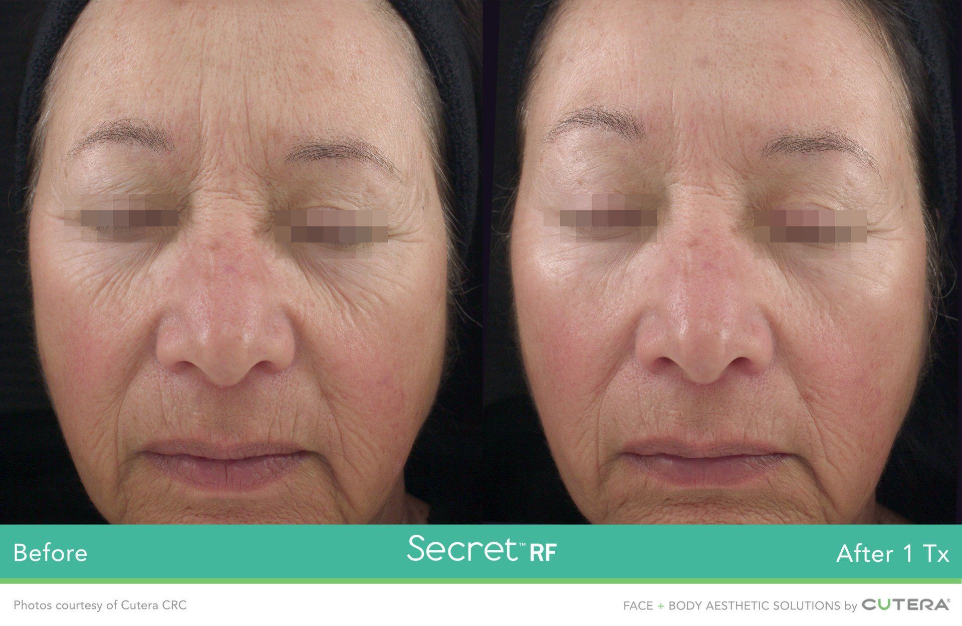 Photo of a woman 's face before and after using Secret RF