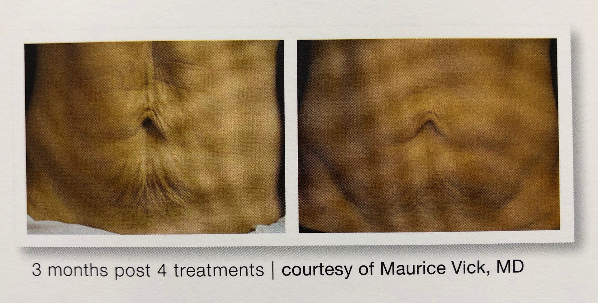 SkinTyte results- A before and after photo of a person's stomach 