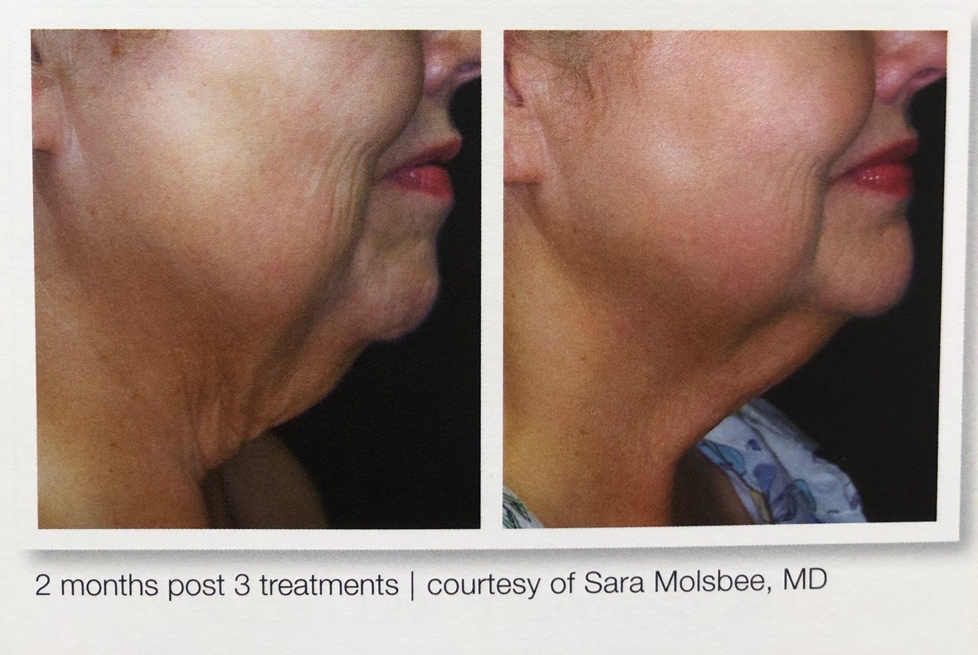 SkinTyte results- A before and after photo of a woman 's neck and face