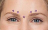 A close up of a woman 's forehead with dots showing injection sites for forehead wrinkles
