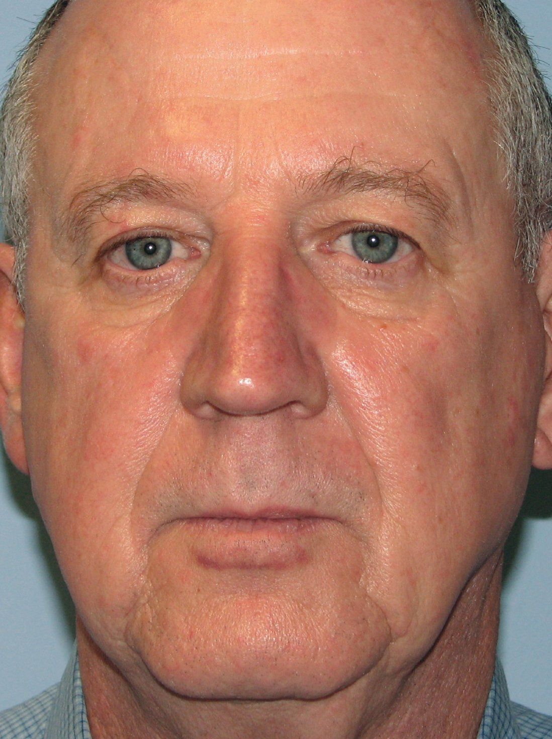 BBL After Photo - A close up of a man's face with much less redness