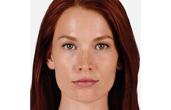 Allergan Fillers after photo