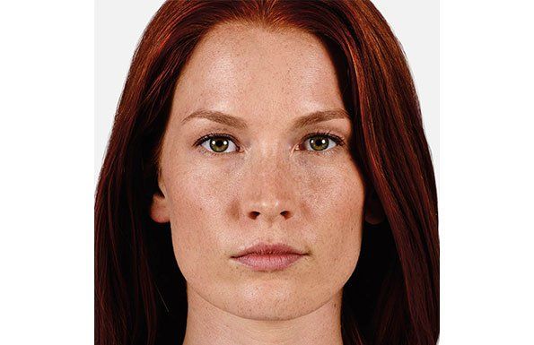 Allergan Fillers before photo