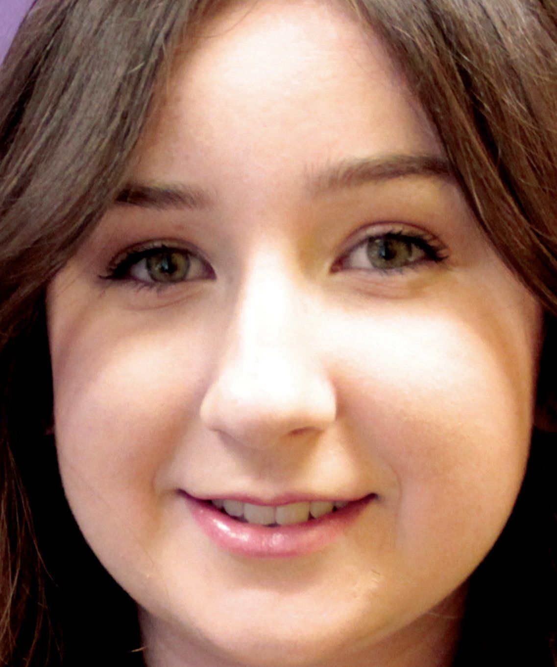 BBL Before Photo - A young woman's face completely clear of acne