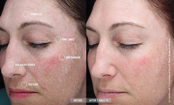 Halo Results- A before and after photo of a woman 's face.