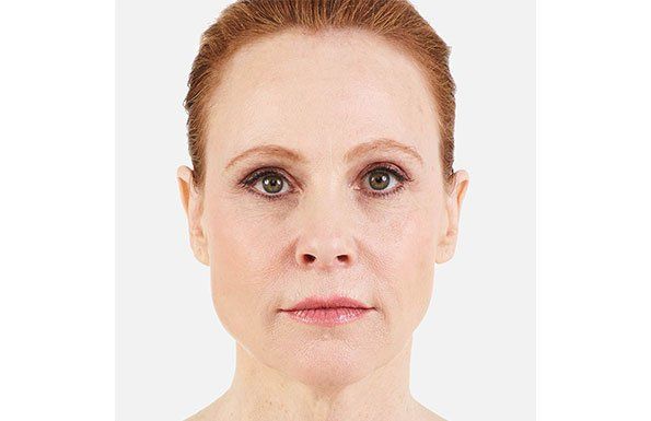 Allergan Fillers after photo