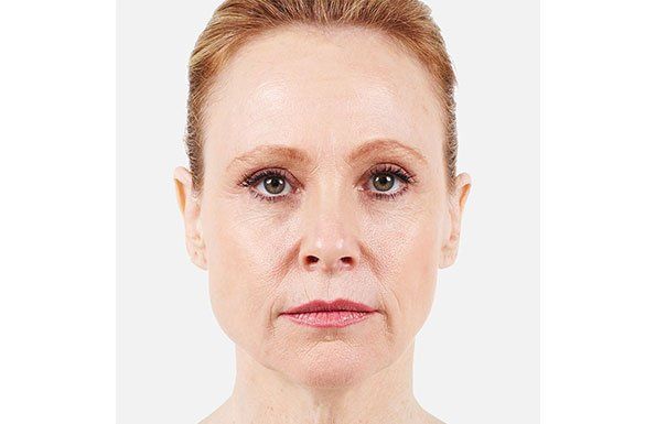 Allergan Fillers before photo