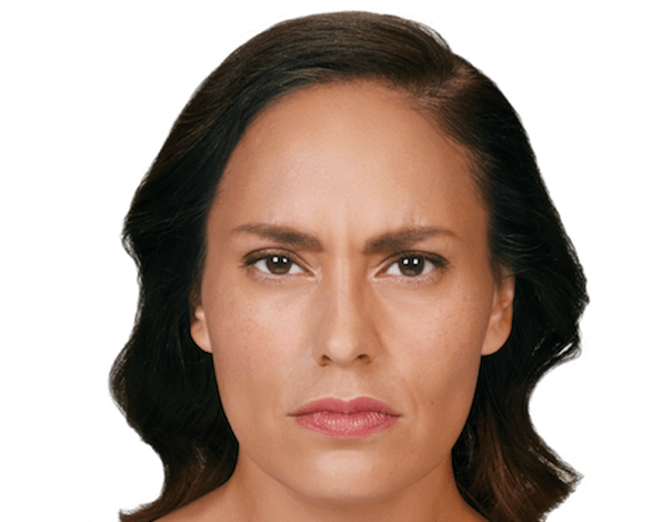 Injectables- after photo