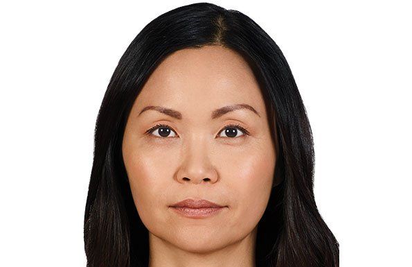 Allergan Fillers after photo